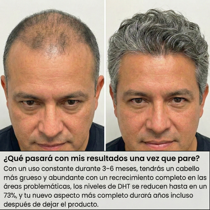 Sistema de regeneración capilar Vroin™